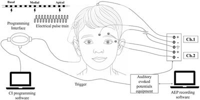 Electrically evoked late latency response using single electrode stimulation and its relation to speech perception among paediatric cochlear implant users